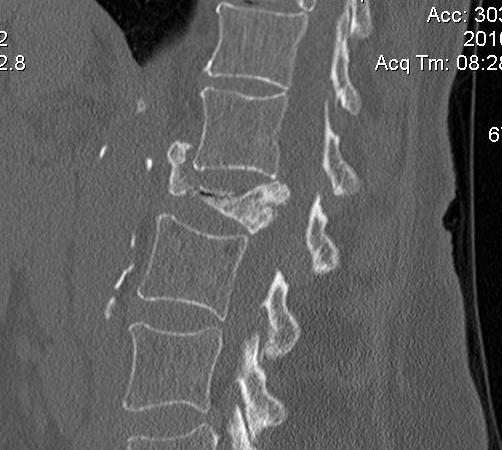 Lumbar Metastasis CT